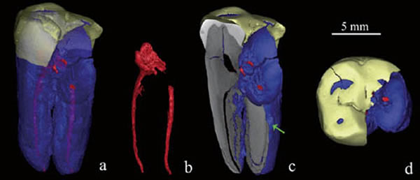 ����II�ű걾CTɨ��3D��ԭͼ��a��b�к�ɫʾ���ѵĳݲ۹ܣ�cΪ��״����Ƭʾ��������������λ�ڲ��ṹ��dΪҧ����ۣ�ʾ����ĥ�ĳ̶ȡ�������ܹ�ͼ��