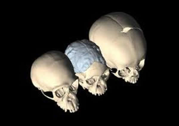 同为4岁的黑猩猩(左)、南方古猿“汤恩儿童”(中)和现代人颅骨愈合情况