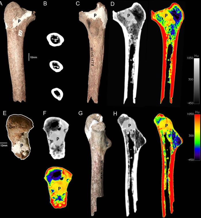 ��¹������ɹǼ���CTͼ��