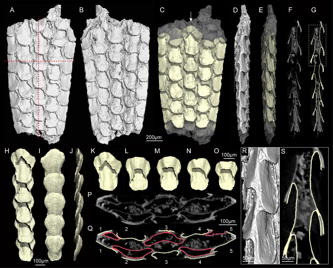 CT��ά�ؽ���ʾ������̦޺�滯ʯ���Ǻ�������ѻ�ʯ�����䶤��