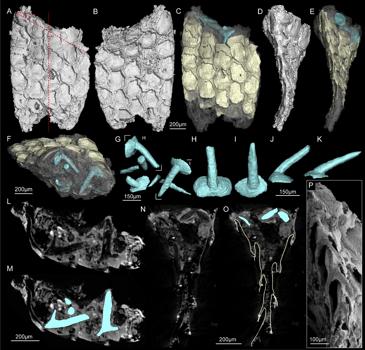 CT��ά�ؽ���ʾ������̦޺�滯ʯ���Ǻ�������ѻ�ʯ�����䶤��