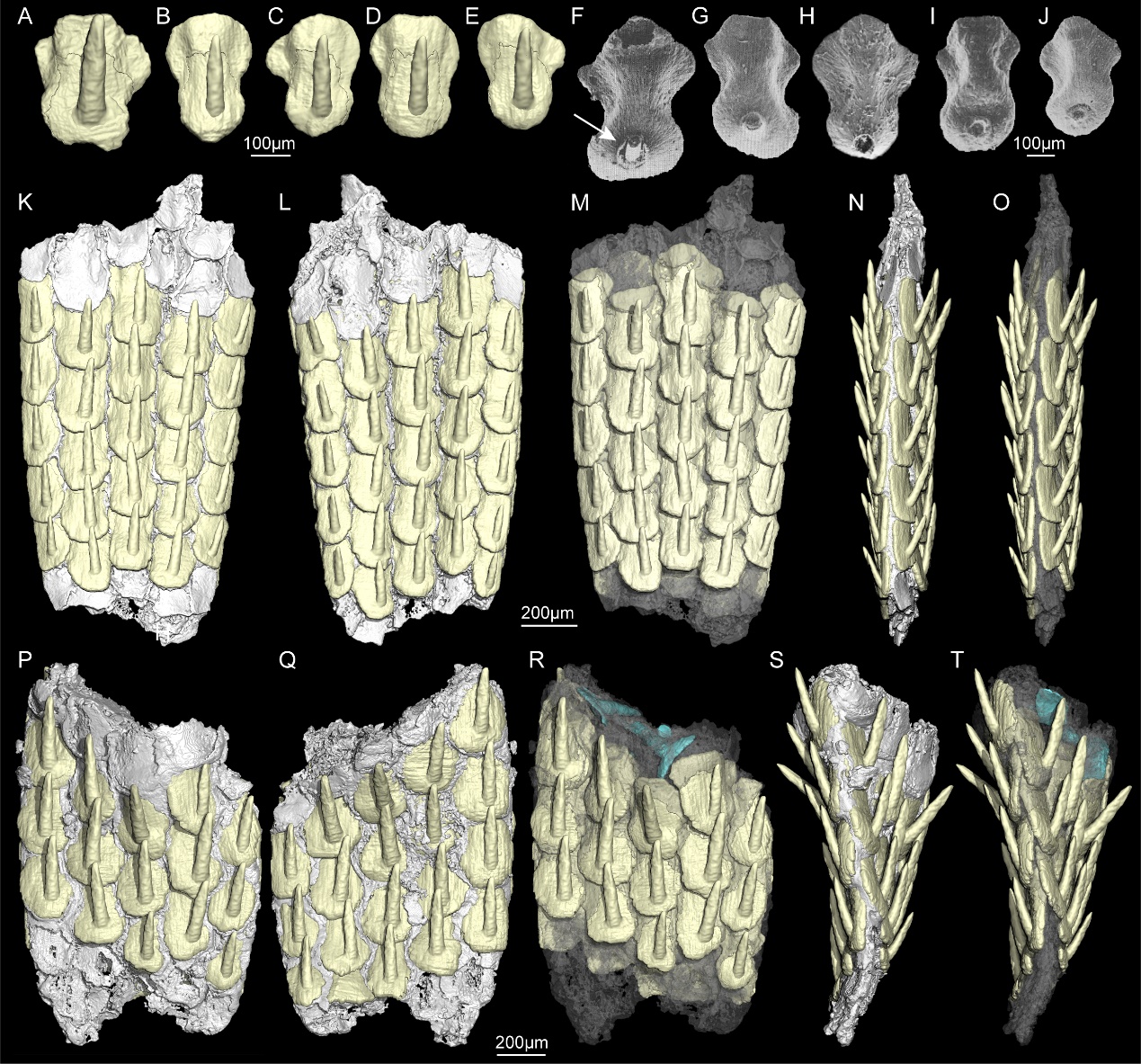 CT��ά�ؽ���ʾ������̦޺�滯ʯ���Ǻ�������ѻ�ʯ�����䶤��